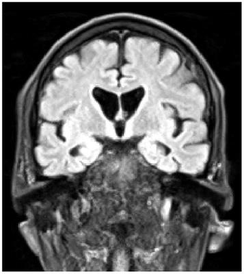 Case report: Clinical lycanthropy in Huntington's disease